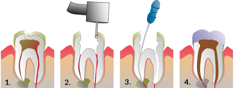 Comfortable & Precise Root Canal Treatmentnt Therapy in San Diego